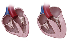 <p>Hypertrophic cardiomyopathy</p>