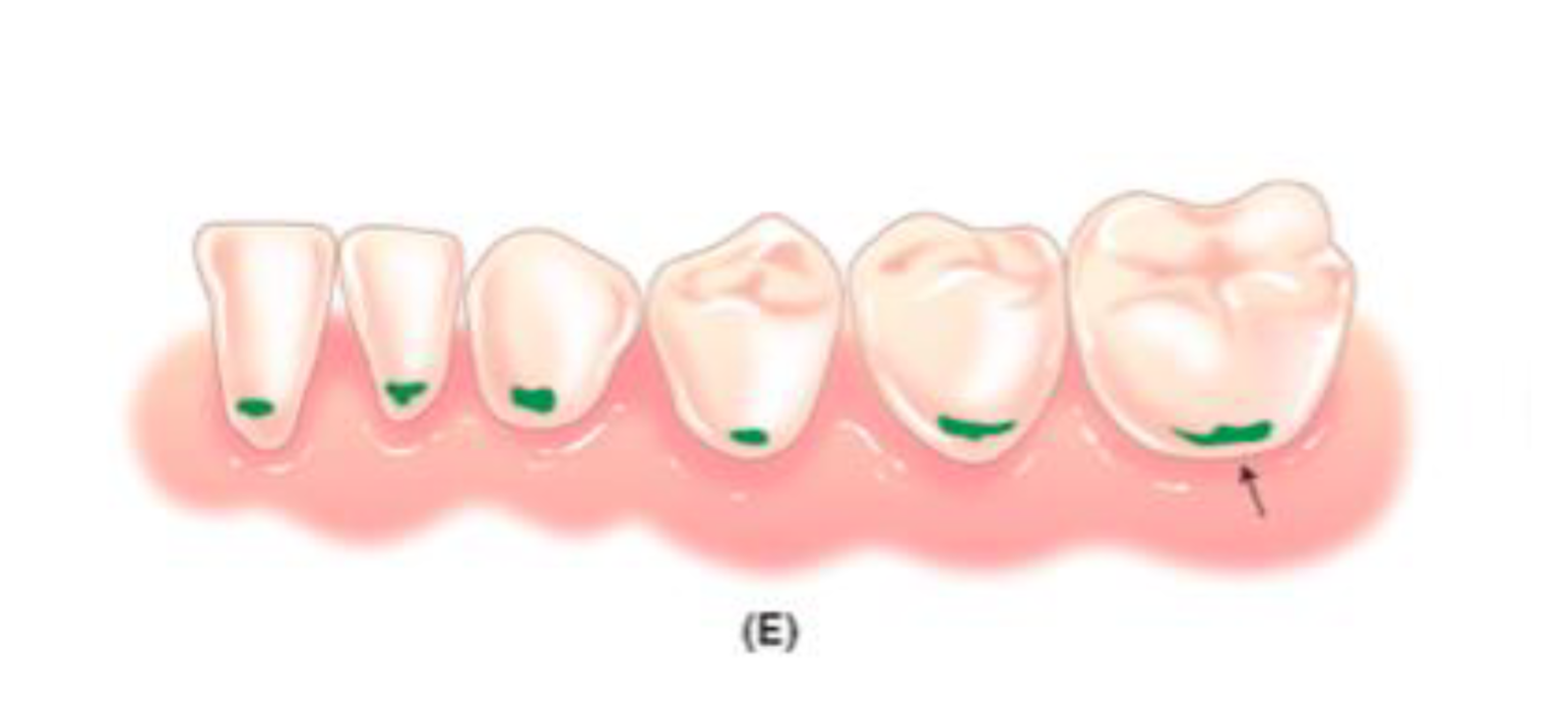 <p>Cervical 1/3 of the facial or lingual surface. usually occur because of sucking on sweets, sodas, and medications. Happens usually by quadrants.</p>