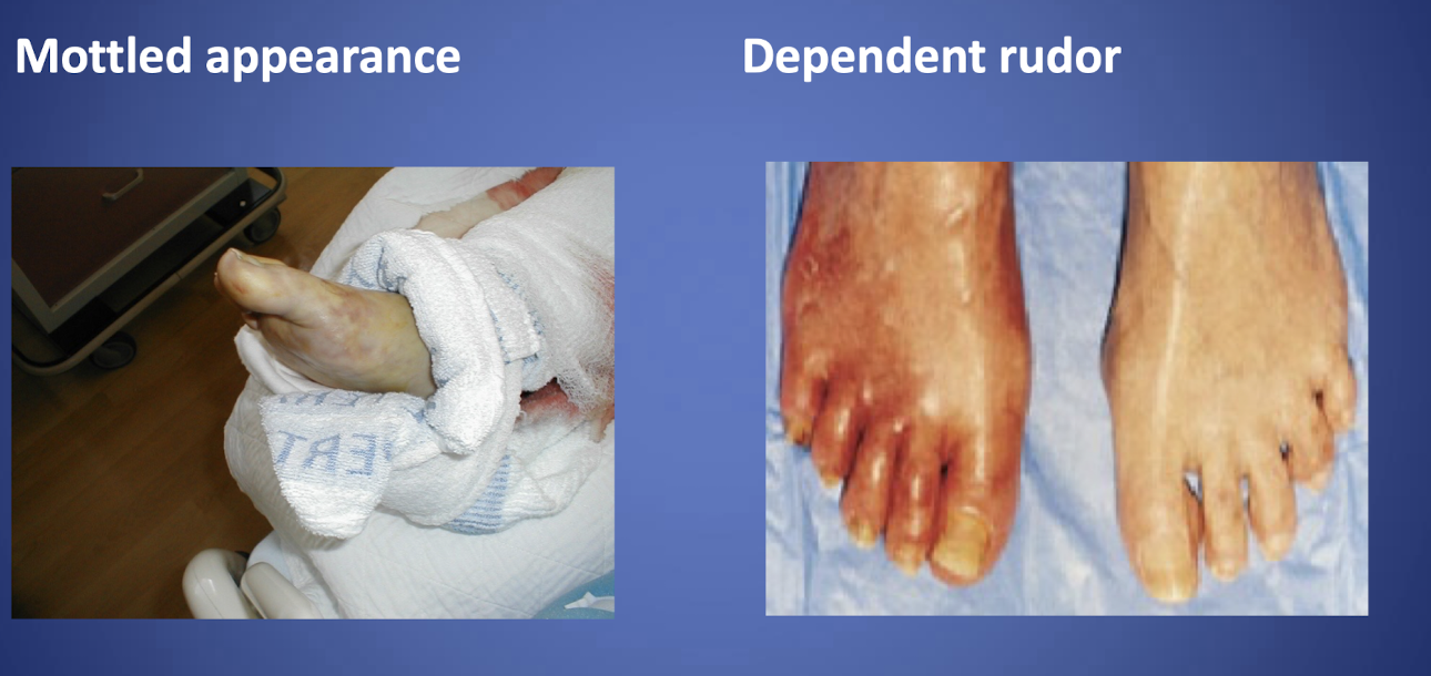 <p>-Mottled appearance </p><p>-Dependent rudor </p><p>-Weak or no pulses, may need a doppler </p><p>-cold or numb toes, brittle nails, necrotic tissues </p>