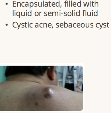 <p>primary lesion fluid filled </p>