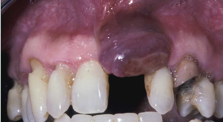 <ul><li><p>relatively common reactive lesion of the gingiva</p></li><li><p>histologically identical to the central giant cell granuloma</p></li><li><p>bluish-purple lesion</p></li><li><p>radiographic- may cause “<strong>cupping</strong>” resorption (<strong>saucerization</strong>)</p></li><li><p><strong>almost exclusively on the gingiva or edentulous alveolar ridge</strong></p></li></ul><p></p>