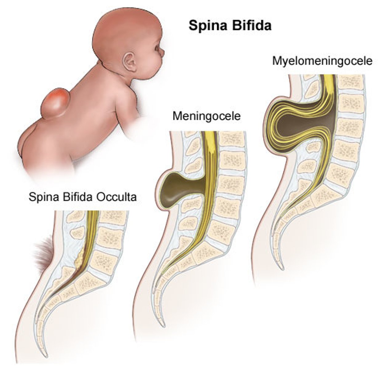 <p>- It's a condition that is an incompletely closed spinal canal, muscle weakness or paralysis, and loss of bladder and bowel control; often accompanied by hydrocephalus, an accumulation of spinal fluid in the brain, and intellectual disability</p><p>- Those who are at risk are 1 in 1,000</p><p>- It can be done through surgery, as this prevents further injury; a shunt placed in the brain drains excess fluid.</p>