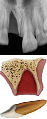 <p>most important factor → <span style="color: red;">time</span></p><p><span style="color: red;">complete displacement</span> of the tooth out of its socket</p><ul><li><p><strong>recommended storage media:</strong></p><ul><li><p><span style="color: red;">water</span></p><ul><li><p><span style="color: red;">least </span>desirable</p></li><li><p>hypotonic → <span style="color: red;">causes cell lysis</span></p></li></ul></li><li><p><span style="color: red;">saliva</span></p><ul><li><p>keeps the tooth <span style="color: red;">moist </span>but is <span style="color: red;">not ideal</span></p></li><li><p><span style="color: red;">in</span>compatible osmolality and pH</p></li><li><p><span style="color: red;">contains bacteria</span></p></li></ul></li><li><p><span style="color: red;">milk</span></p><ul><li><p>best <span style="color: red;">readily available </span>alternative</p></li><li><p><span style="color: red;">co</span>mpatible pH and osmolarity</p></li><li><p>helps <span style="color: red;">maintain the vitality of PDL</span> cells</p></li></ul></li><li><p><span style="color: red;">hank’s balanced salt solution (HBSS)</span></p><ul><li><p><span style="color: red;">most ideal</span> storage medium</p></li></ul></li></ul></li></ul><p></p>