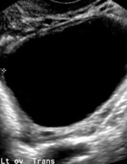 <p>Uncomplicated, usually referring to cysts</p><p>Anechoic, unilocular, thin smooth wall, no blood flow</p>