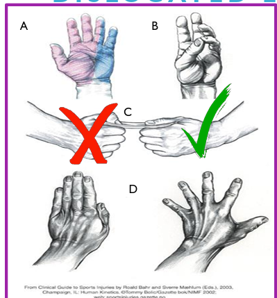 <ul><li><p>innervates gun fingers</p></li><li><p>if median n intact, the thumb can be rotated and flexed towards the pulp of the index finger (Opp. Pol. mm)</p></li></ul><p></p>