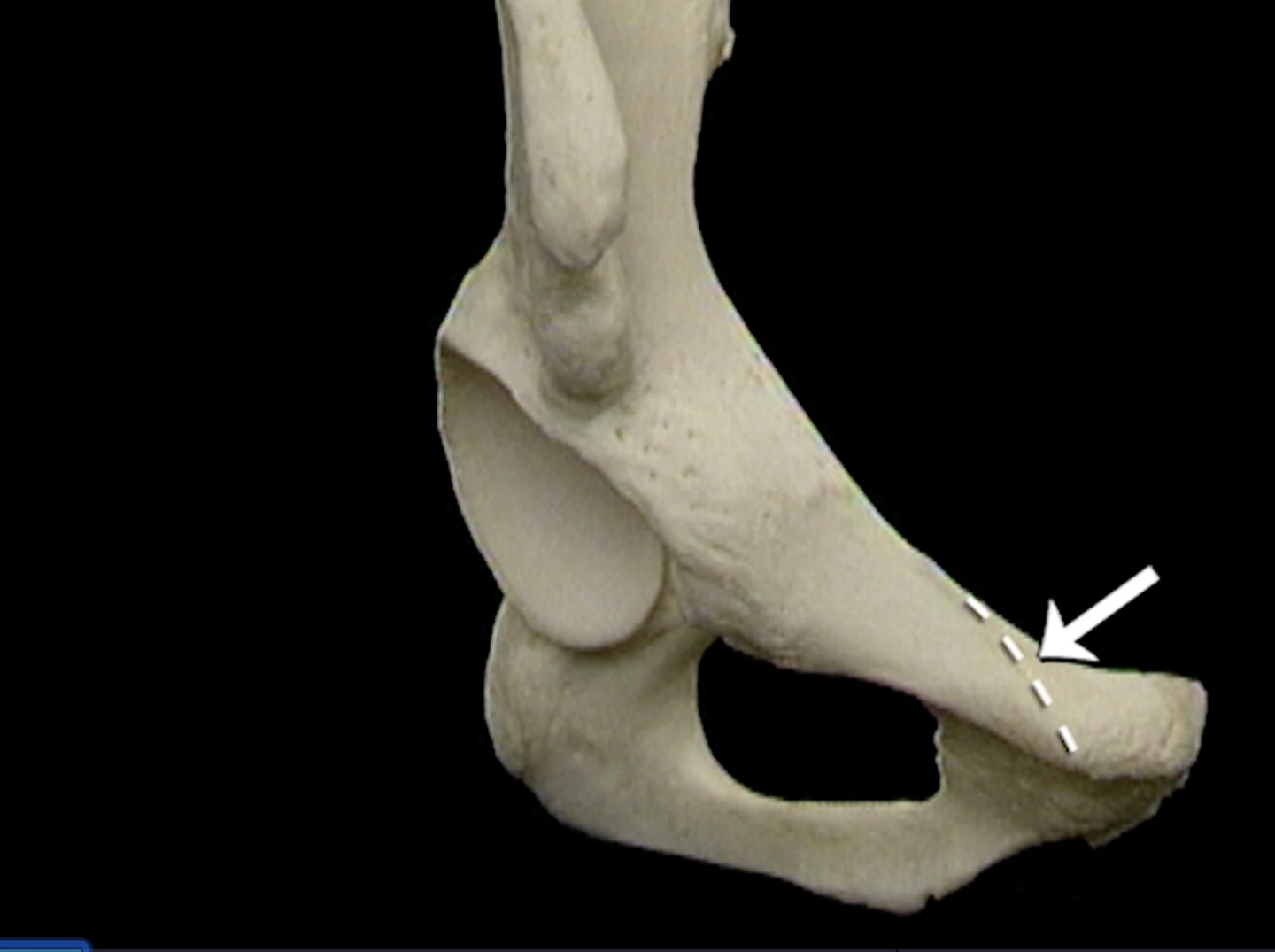 <p>ridge on superior ramus of pubis - attachment point for psoas minor and conjoint tendon of transverse abdominis m. and internal abdominal oblique m.</p>