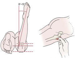 <p>prone w/ knee bent to 90</p><p>internally rotate the hip</p><p>palpate the greater trochanter at its most prominent place during hip rotation</p><p>look at foot position</p>