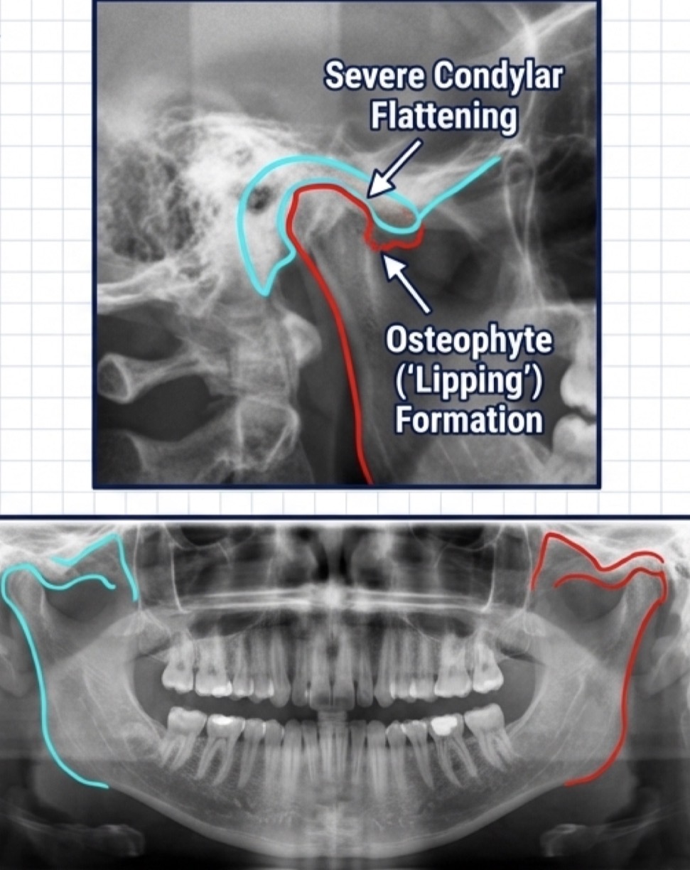 <p>Destructive disorder of subarticularbone and articular surfaces- not mainly inflam initially </p><p>Chronic overload (freq dislocations) excess capacity for cellular adaptation </p><p>Unilateral joint pain (worsens at end of day), crepitus (sand like noise) and soft end feel </p><p>Severely flat condyle, osteophyte (lipping) formation and cortical erosion </p><p>Radical reduction of mechanical load via occlusal appliances, soft diet and NSAIDs</p>