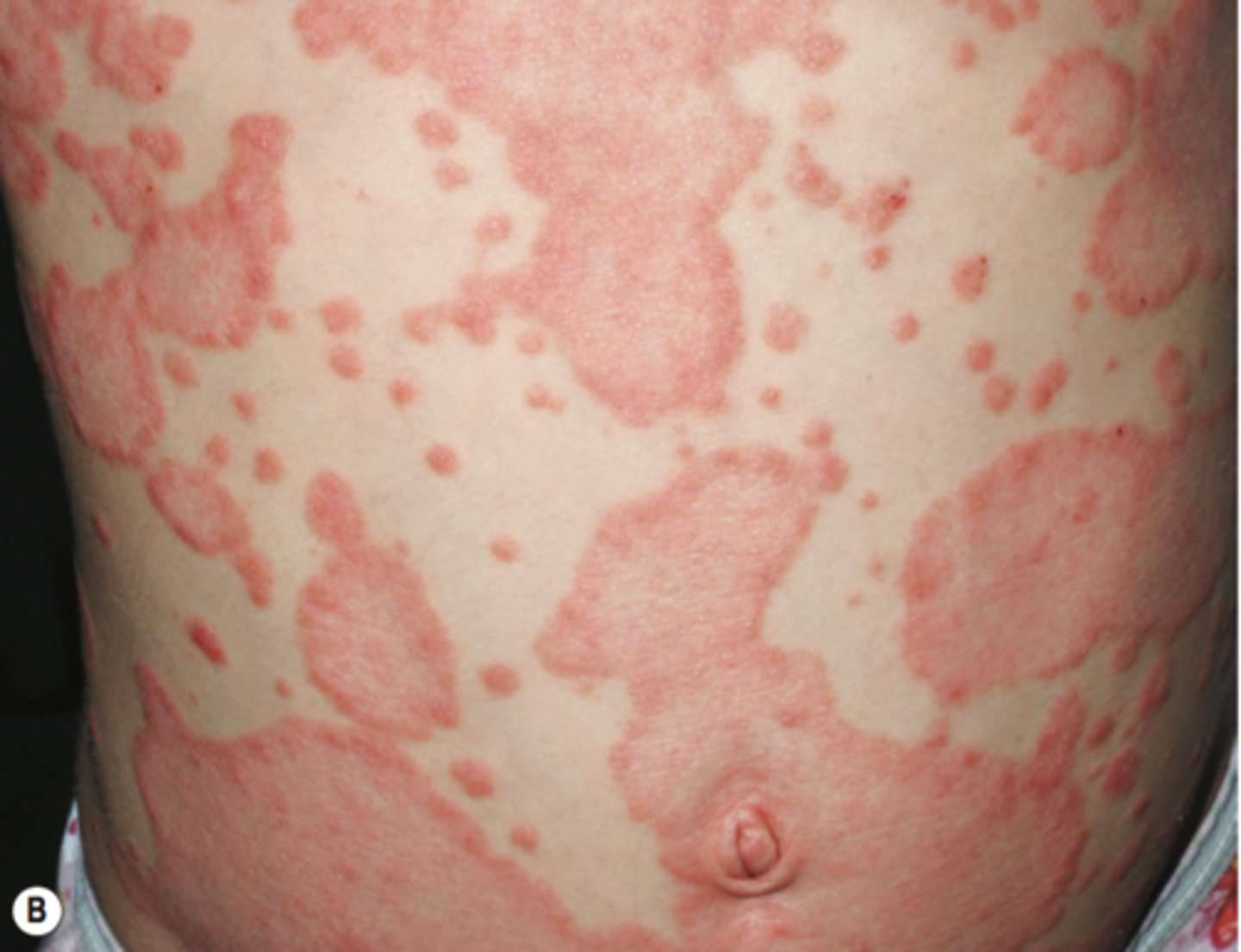 <p>- occurs after streptococcal pharyngitis or exposure to strep</p><p>- 2-10 mm salmon pink papules with or without scales</p><p>- may progress into chronic plaque psoriasis</p>