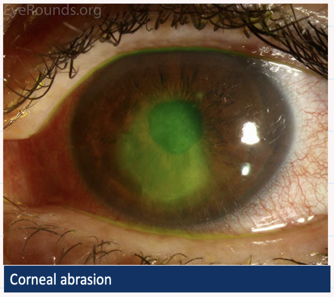 <ul><li><p>PAINFUL, red watery eye </p></li><li><p>Photophobia </p></li><li><p>FB sensation </p></li></ul><p></p><p>SIGNS → epithelial defect which stains with fluroescein </p><p></p>