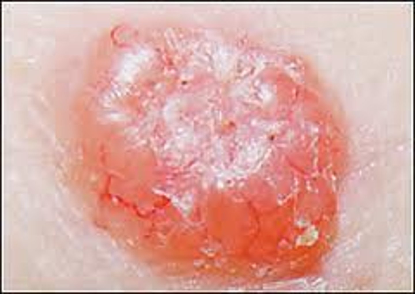 <p>oval, pink, pearly papule</p><p>-most common cancer in the world</p><p>-pink patch that does not leave</p><p>-pink lesions that leave a depressed center with firm elevated border</p><p>-caused by UV exposure</p>