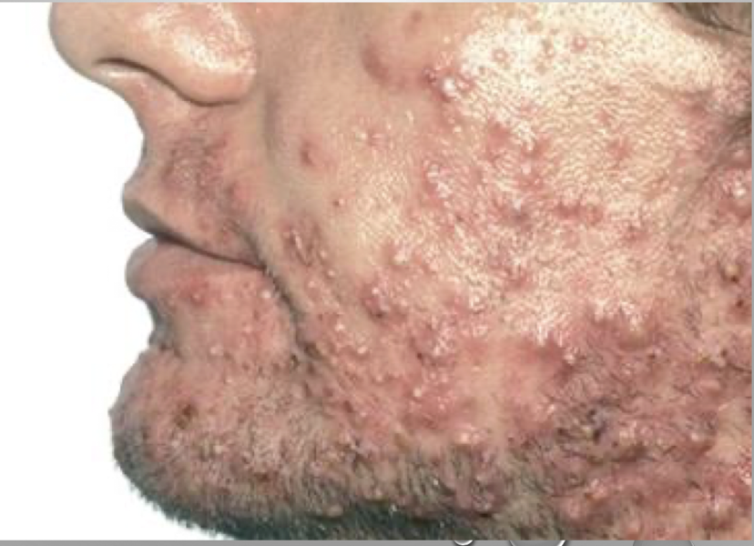 <p>benign: inflammatory disorder of the sebaceous glands; more common in teenagers, may worsen with hormone fluctuations </p><p>symptoms: various sizes of blackheads and whiteheads, may include papules and pustules, most common of face, neck and upper back</p><p>treatment: topicalâmechanical removal of multiple lesions with extractor, topical solutions (benzoyl peroxide, retinoids, antimicrobials); systemicâantibiotics (Isotrerinoin) </p>