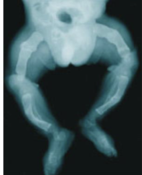 <p>osteogenesis imperfecta</p>