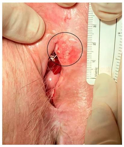 <p>Squamous cell carcinoma is the MC type</p><p>-RF: HPV types 16 and 18, postmenopausal </p><p>-Presentation: vulvar pruritis, bleeding, or pain that is MC limited to the labia majora. Red or white ulcerative or raised crusted lesion on vulva </p><p>-Dx: biopsy, colposcopy </p><p>-Tx: surgical excision, radiation, chemotherapy </p>