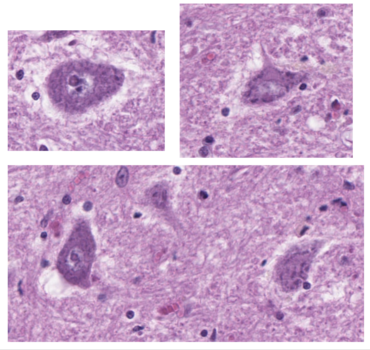 <p><span style="font-family: "Calibri Light";">The cytoplasm of these large motor neurons has dark staining (basophilic) clumps that create a granular appearance. <br><br>What do we call these basophilic clumps?<br><br>What makes them basophilic?</span></p>