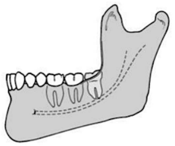 <p>occlusal plane is at the <span style="color: red;">same level </span>as the occlusal plane of the second molar</p>