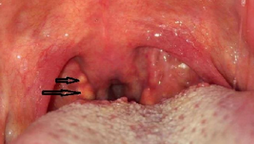 <p>an example of nodules that is seen on the lingual tonsils in lateral base of the tonguefoliate papilla</p>