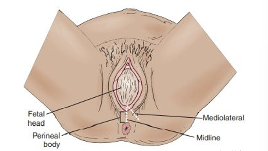 <p>a surgical incision of the perineum that is performed to facilitate birth. The most common method is the <mark data-color="yellow" style="background-color: yellow; color: inherit;">midline or median</mark>. An incision is made from the <mark data-color="yellow" style="background-color: yellow; color: inherit;">vaginal opening</mark> downward toward the <mark data-color="yellow" style="background-color: yellow; color: inherit;">rectum</mark></p>