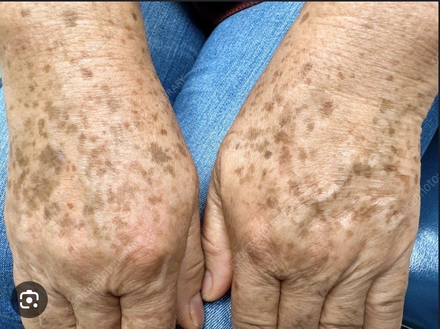 <p>Aging spots</p>