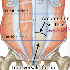 <p>Inferior border of the posterior rectus sheath; below it all three aponeuroses pass anterior to rectus abdominis and the posterior surface is mainly covered by transversalis fascia </p>