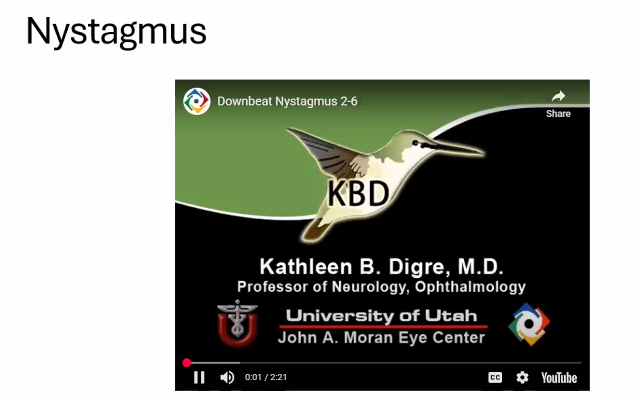 <p>jerking eye movement (tiny but still there) </p>