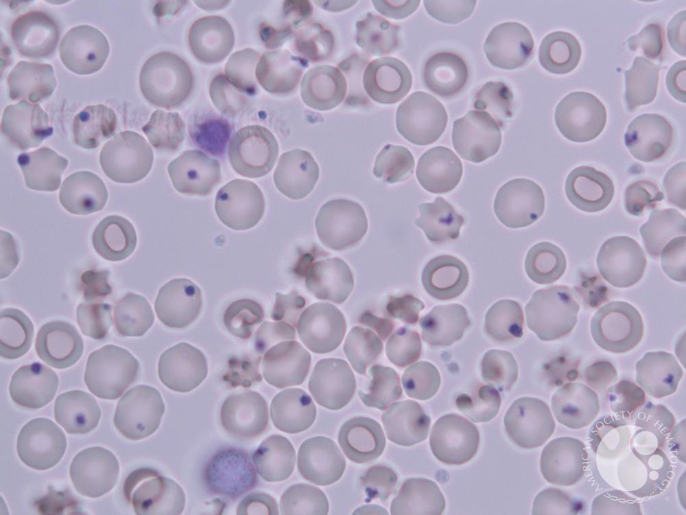 <p>Only seen with a Supravital stain. Dark blue to purple spots</p>