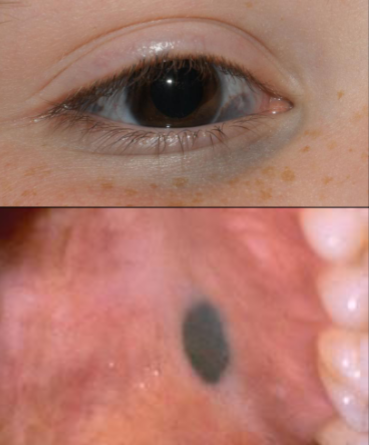 <p>Appears as a macular or dome-shaped, blue or blue-black lesion smaller than 1 cm in diameter usually in childhood or YA and females.</p>