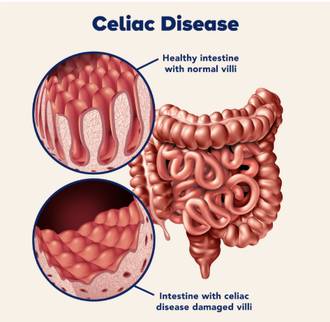 <p><span style="line-height: 107%;"><strong>BOOK:</strong></span></p><p class="MsoNormal"><span style="line-height: 107%;">Immunological or allergic reaction to the protein gluten in certain grains, such as wheat and rye. The effect is to destroy the intestinal enterocytes, resulting in a much reduced surface area due to flattening of the villi. Elimination of wheat, rye, and certain other grains from the diet restores the intestinal surface.</span></p><p class="MsoNormal"><span style="line-height: 107%;"><strong>SIMPLE:</strong></span></p><p class="MsoNormal">A condition in which the <span style="font-family: Calibri, sans-serif;">immune system reacts to gluten</span>, damaging the <span style="font-family: Calibri, sans-serif;">small intestine</span> and affecting nutrient absorption.</p>