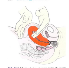 <p>Bladder Interference</p><p>Intervention (image)</p>