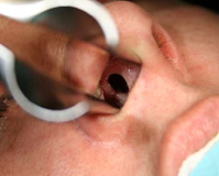 <p>What are causes of septal perforation/ulceration?</p>