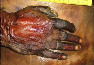 <p>Questions</p><ol><li><p>What postmortem change is shown affecting the hand?</p></li><li><p>What are the specific physical and color changes observed in the skin during this process?</p></li></ol><div data-type="horizontalRule"><hr></div><p></p><p></p>