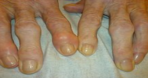 <p>What type of arthritis is this?</p>