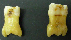 <p>enlargement of the body and pulp chamber of a multirooted tooth </p><ul><li><p>characterized by:</p><ul><li><p>an <span style="color: red;">elongated pulp chamber</span>.</p></li><li><p><span style="color: red;">apical displacement </span>of the pulpal floor.</p></li></ul></li><li><p>effects on root anatomy:</p><ul><li><p>root furcation is displaced apically</p></li><li><p>individual roots become greatly shortened</p></li><li><p>overall<span style="color: red;"> root length</span> may remain <span style="color: red;">normal</span>.</p></li></ul></li><li><p>development:</p><ul><li><p>root furcation forms through<span style="color: red;"> invagination of Hertwig's epithelial root sheath</span></p></li><li><p>bc of this developmental process, many ectodermal dysplasias exhibit this condition</p></li></ul></li></ul><p></p>