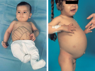 <ul><li><p><strong>def. a-1,6-glucosidase </strong>(debrancher) (liver + some muscle)</p></li><li><p>mild von Gierke BUT: less severe hypoglycemia, NO lactic acidosis</p></li><li><p><strong>weak bones, skeletal/cardiac muscle weakness, fasting ketosis </strong>(ketones in urine), inc. AST/ALT</p></li></ul><p></p>