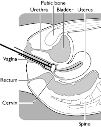 <p>Tandem + ring- cervix </p>