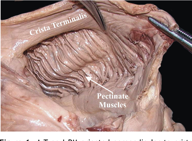 <p>parallel muscular ridges on the inner walls of the heart's atria that look like the teeth of a comb</p>