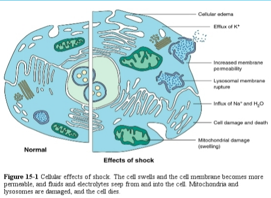 <p>widespread abnormal cellular metabolism that occurs when oxygenation and tissue perfusion needs are not met to the necessary level to maintain cell function. <strong>identified thru perfusion and oxygenation.</strong></p><p>aerobic metabolisms turn anaerobic → increased lactic acid → metabolic acidosis</p><p><strong><u>types:</u></strong></p><ul><li><p><u>hypovolemic:</u> inadequate volume</p></li><li><p><u>cardiogenic:</u> inadequate pump</p></li><li><p><u>distributive:</u> ineffective vasculature</p><ul><li><p>neurogenic, chemical (anaphylaxis, sepsis, capillary leak), obstructive</p></li></ul></li></ul><p></p><p><strong><u>stages (need to know all info):</u></strong></p><ul><li><p><u>initial:</u> <strong>box 31.3 pg 764</strong></p><ul><li><p>MAP drops 5-10 mm Hg from baseline; vasoconstriction </p></li><li><p>raise in HR or tachycardia for no reason</p></li><li><p>slight raise in RR</p></li><li><p>slight vasoconstriction, paler skin</p></li><li><p>normal UOP</p></li><li><p>sense of impending doom</p></li><li><p>normal acid base</p></li></ul></li><li><p><u>nonprogressive/compensatory</u></p><ul><li><p>MAP drops 10-15 mm Hg from baseline</p></li><li><p>raise in HR, possibly tachycardic, continued sympathetic stimulation</p></li><li><p>raise in RR, SpO2 drops 2-5% from baseline</p></li><li><p>skin is pale and cool, blood shunts away from extremities and more toward organs</p></li><li><p>UOP decreases slightly, increased thirst</p></li><li><p>anxiety, fear, sense of urgency</p></li><li><p>mild metabolic acidosis</p></li></ul></li><li><p><u>progressive</u></p><ul><li><p>MAP >20 mm Hg from baseline</p></li><li><p>HR tachycardic but pulses weak due to shunting</p></li><li><p>tachypneic, resp distress</p></li><li><p>O2 drops 5-20% from baseline</p></li><li><p>skin is pale, cool, and diaphoretic (anoxia to non-essential organs, no skin perfusion). possible cyanosis in nail beds and oral mucosa</p></li><li><p>UOP little to none. dark and concentrated. increased BUN/Cr</p></li><li><p>confusion, agitation, brain is less perfused</p></li><li><p>metabolic acidosis + hyperkalemia</p></li></ul></li><li><p><u>refractory (irreversible)</u></p><ul><li><p>MAP <65 mm Hg. cannot be maintained via fluids, vasopressors, etc.</p></li><li><p>HR is messed up. tachy, brady, dysrhythmia, vtach, etc. severe hyperkalemia. acidic blood.</p></li><li><p>resp failure, intubated.</p></li><li><p>no peripheral pulses, maybe carotids. SpO2 not measurable due to constriction + coldness. skin is mottled, dusky, grey, cold.</p></li><li><p>no UOP</p></li><li><p>unresponsive, coma, seizure activity</p></li><li><p>resp (due to no CO2 release) and metabolic (mixed) acidosis. severe hyperkalemia.</p></li></ul></li></ul><p><strong><u>cellular (pic):</u></strong></p><ul><li><p>walls more permeable, efflux of K, influx of Na and H2O, cell membrane + organelles swell</p></li><li><p><strong>blood hyperkalemia and blood hyponatremia</strong></p></li></ul><p></p>