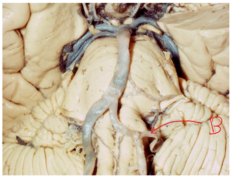 <p>What kind of nuclei damage, and hence symptoms can we expect to see from damaging artery B? what is the name of this syndrome?</p>