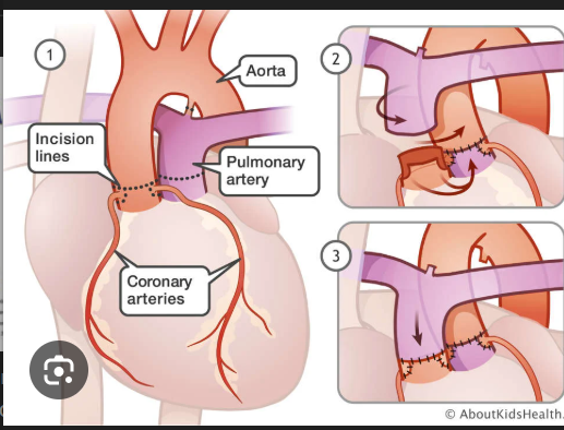 <p>• Full surgical correction happens at 2 weeks of life • </p><p>Requires surgical switch of the great arteries called a Jatene procedure • </p><p>Prognosis post surgery is excellent</p>