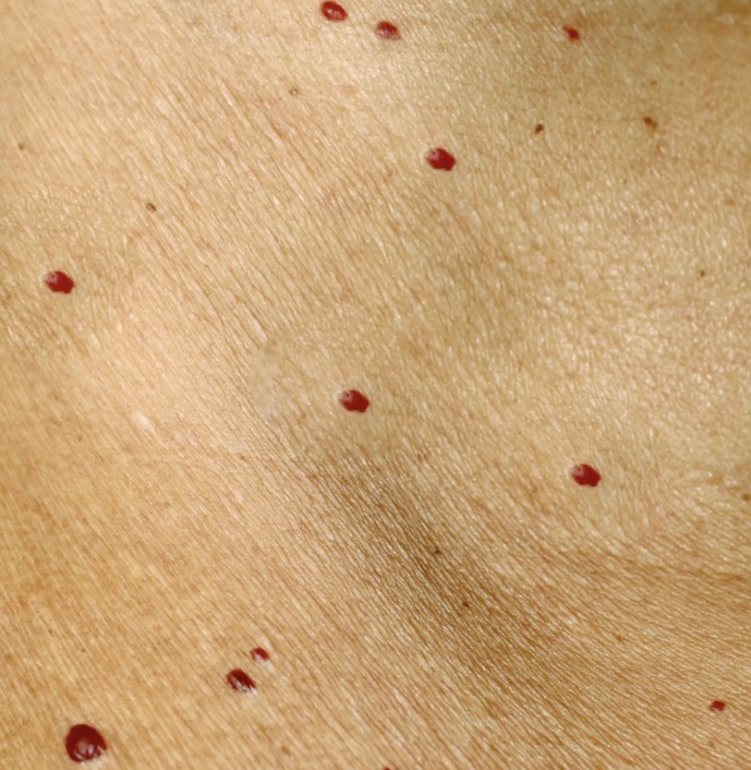 <ul><li><p>“Cherry” angiomas </p></li><li><p>Benign </p></li><li><p>Bright red skin growth</p></li></ul><p></p>
