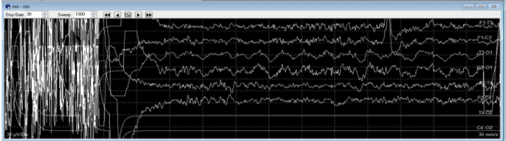 <p>Amplifer saturation can be caused by:</p>