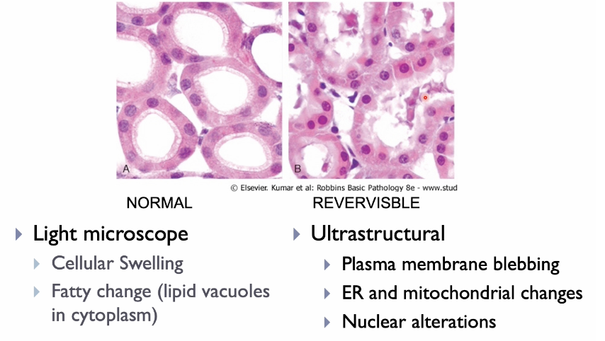 <ul><li><p><span>Reversible injury - recovery if damaging stimulus is removed. Compromise cell function. May compromise organ function.</span></p><ul><li><p><span>Reversibly injured monocytes (transient ischemia) may be transiently non-contractile which will affect function of the heart.</span></p></li></ul></li><li><p><span>Morphological features of injury-light microscope</span></p><ul><li><p><span>Cell swelling.</span></p></li></ul></li></ul><ul><li><p><span>Irreversible injury and cell death: when the cell cannot recover and it dies. Two types of cell death which differ in morphology, cause and roles in disease.</span></p><ul><li><p><span>Necrosis</span></p></li><li><p><span>Apoptosis</span></p></li></ul></li><li><p><span>May have occurred before morphological changes become apparent.</span></p></li></ul><p></p>