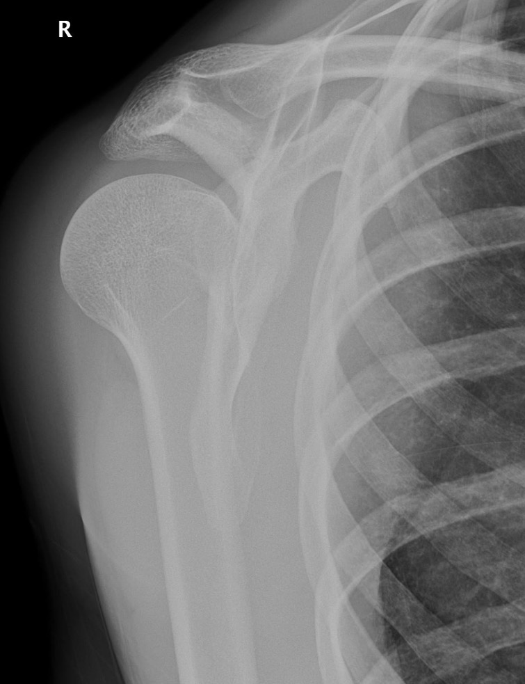 <ul><li><p>Less common</p></li><li><p>Lightbulb appearance</p></li><li><p>No overlap on lateral view</p></li></ul><p></p>