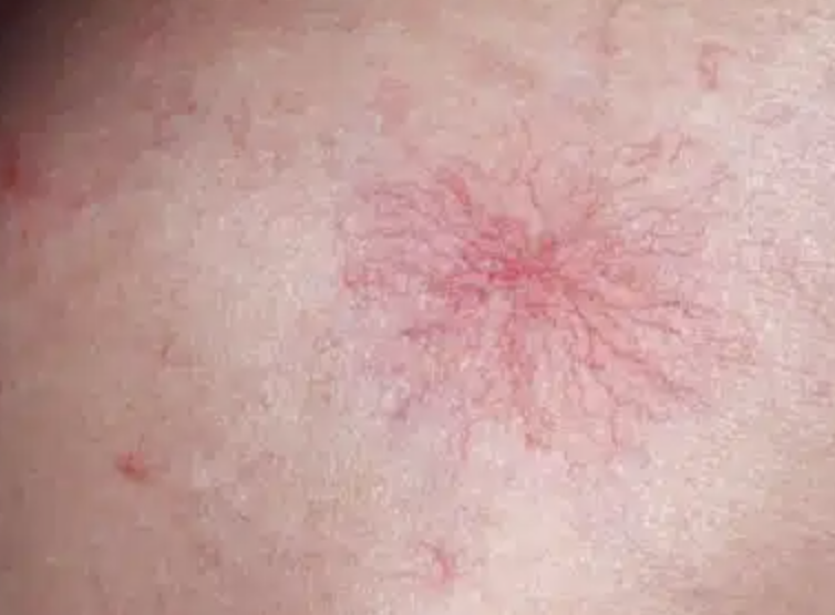 <p>Vascular lesion - vascular spider </p>