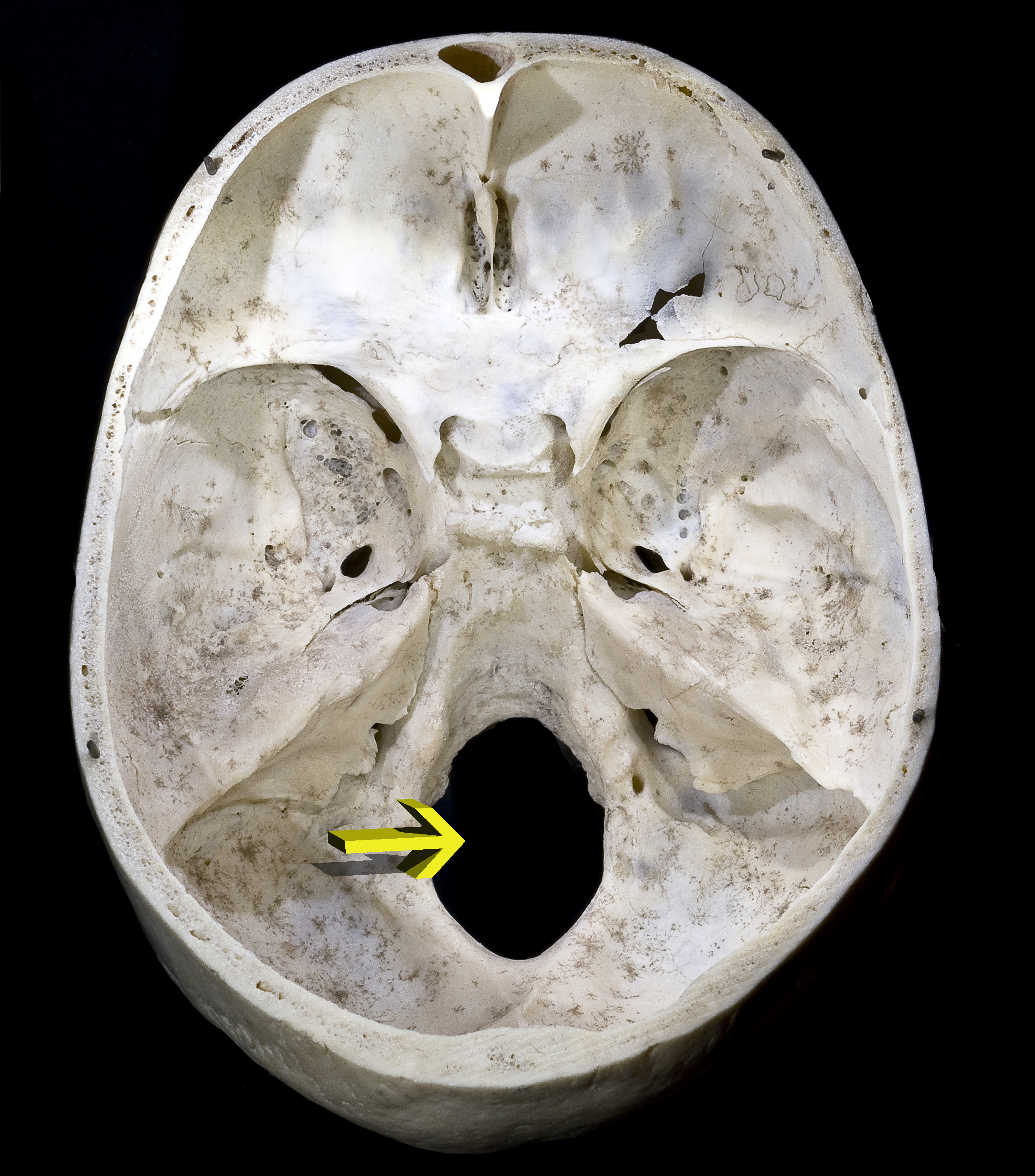 <p>hole in bone also allowing passage of a vessel</p>