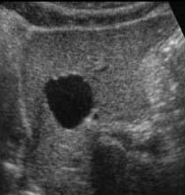 <p>PT is asymptomatic, what is the dx and describe the sonography</p>