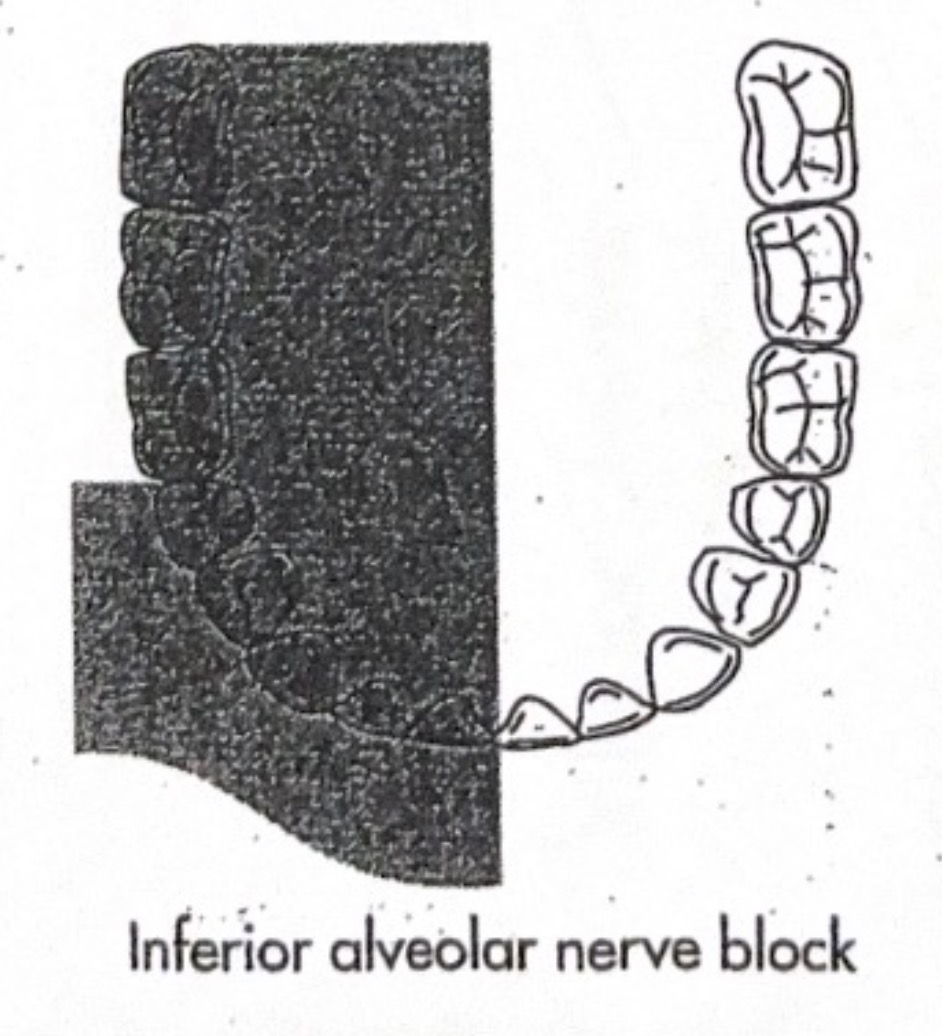 <p>Inferior alveolar (IANB)</p>