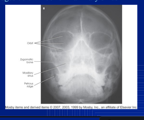 <p>full bony nasal septum</p><p>pet ridges below maxillary sinus</p>
