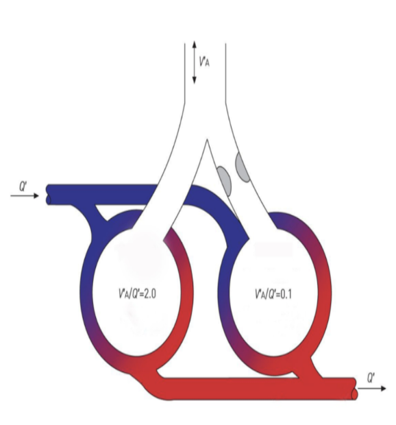 <p>shunt</p><p>= bv veroorzaakt door obstructie van luchtwegen → bloed dat door de alveoli gaat kan onvoldoende O<sub>2</sub> opnemen en CO<sub>2</sub> afgeven → lichaam reageert hierop door lage P<sub>A</sub>O<sub>2</sub>, omdat dit hypoxische vasoconstrictie geeft = alveolaire bloedvaten gaan samenknijpen → verkleind de V/Q mismatch lichtelijk</p>