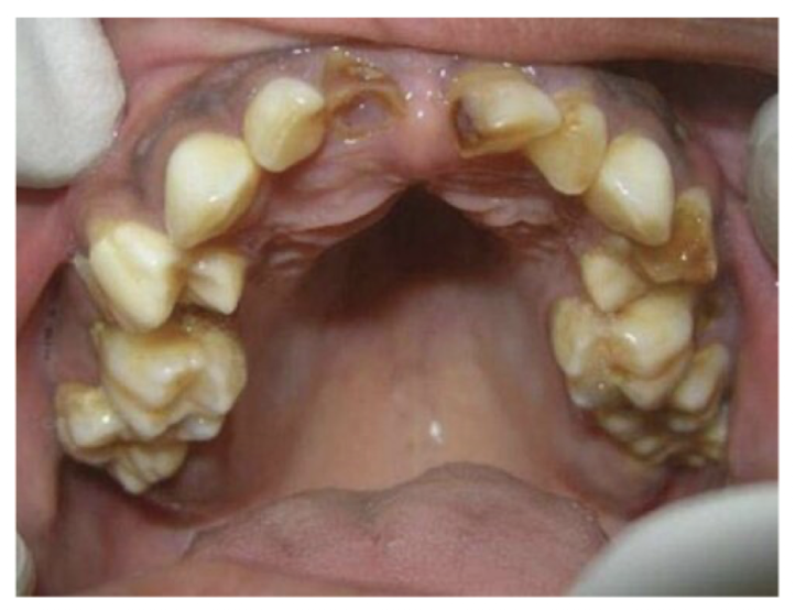 <ul><li><p>tall and narrow U-shaped palate (arc instead of flat)</p></li><li><p>similar pathogenic mechanism of CP</p></li><li><p>feeding difficulties</p></li><li><p>can cause tooth crowding</p></li></ul><p></p>